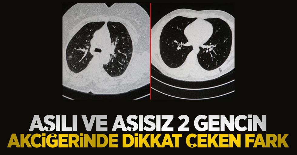 Aşılı ve aşısız 2 gencin akciğerinde dikkat çeken fark