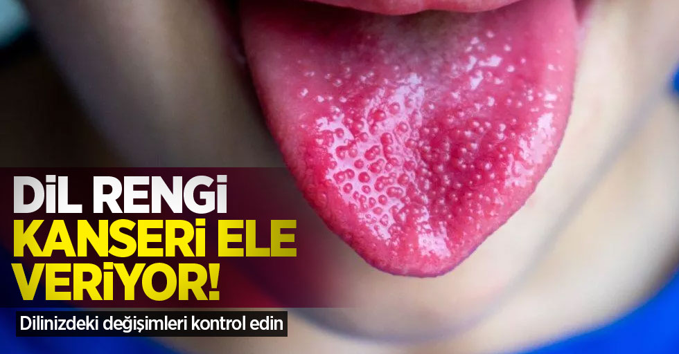 Dil rengi, kanseri ele veriyor! Dilinizdeki değişimleri kontrol edin
