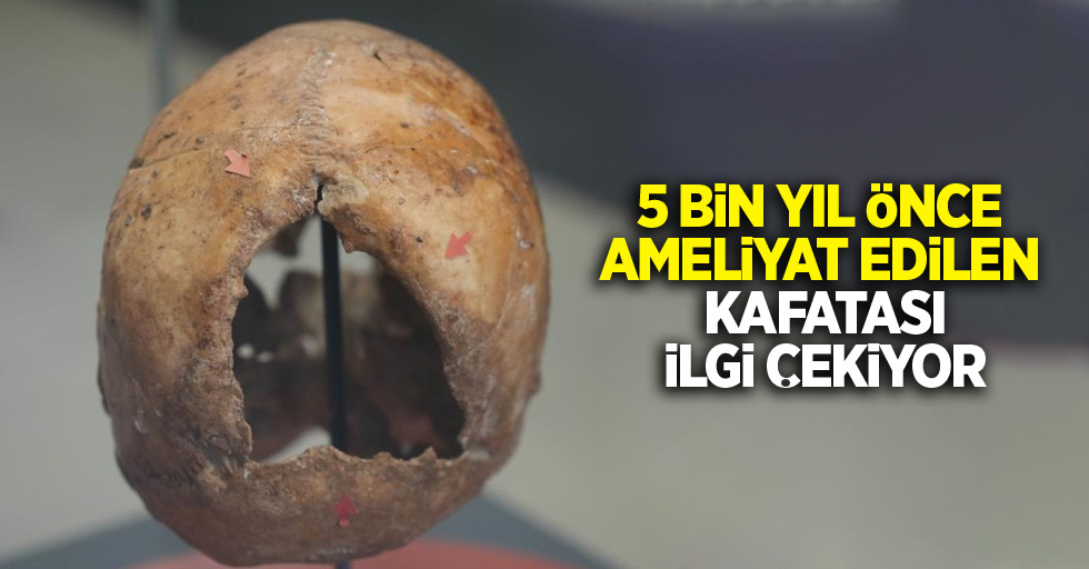 5 bin yıl önce ameliyat edilen kafatası ilgi çekiyor