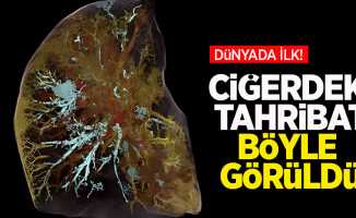 Dünyada ilk! Koronavirüsten ölen kişinin ciğerlerindeki tahribat görüntülendi